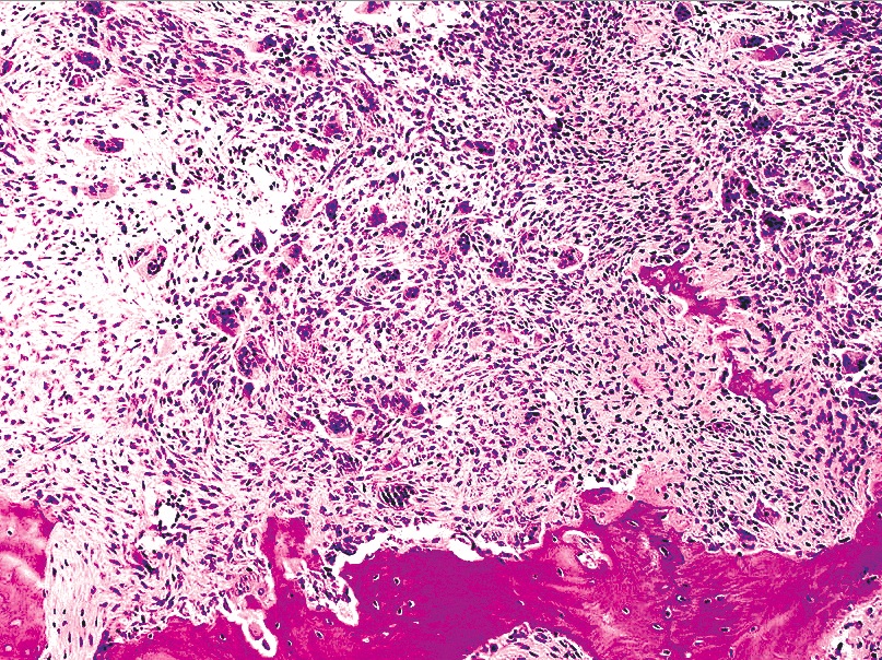 Pathology Outlines Giant Cell Granuloma